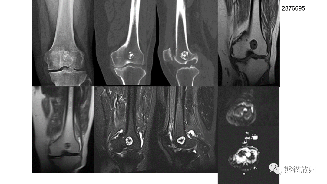 【病例】软骨肉瘤I级 VS 去分化软骨肉瘤-44