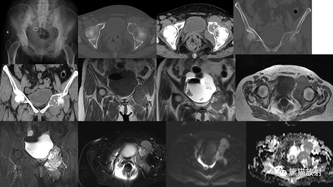 【病例】软骨肉瘤I级 VS 去分化软骨肉瘤-22