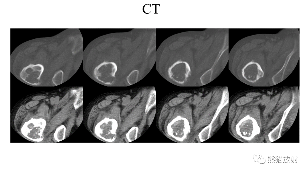 【病例】软骨肉瘤I级 VS 去分化软骨肉瘤-4