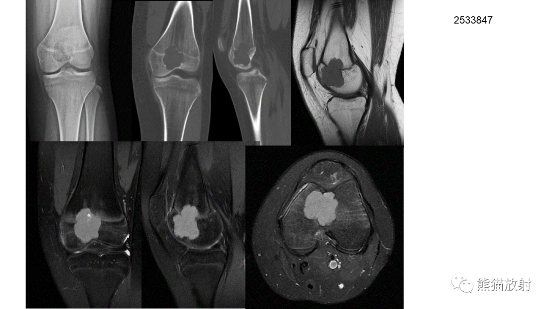 【病例】软骨肉瘤I级 VS 去分化软骨肉瘤-55