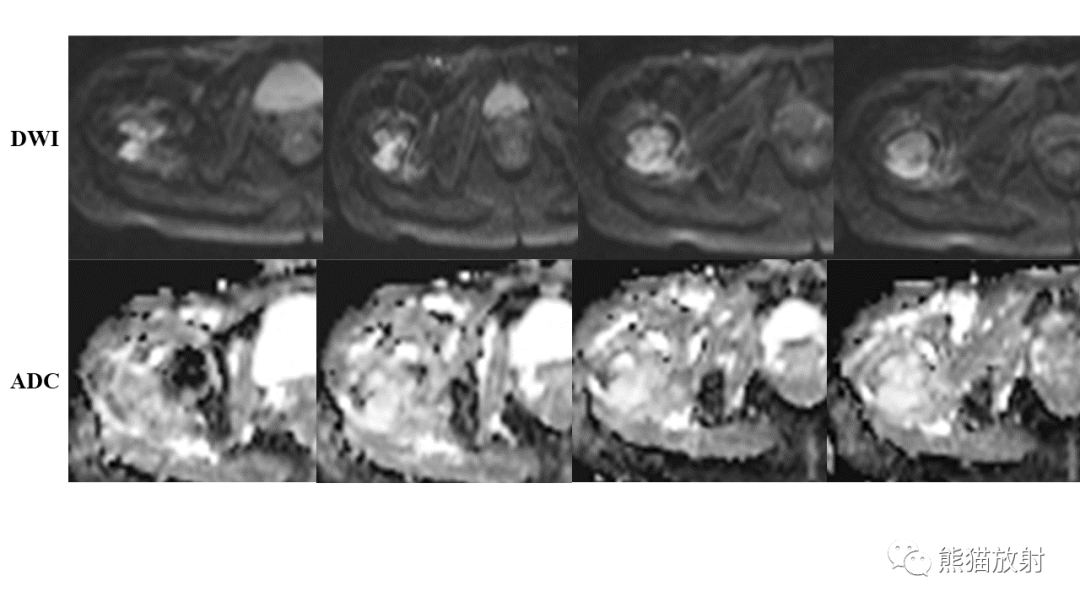 【病例】软骨肉瘤I级 VS 去分化软骨肉瘤-9