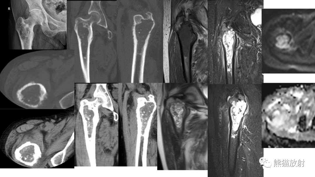 【病例】软骨肉瘤I级 VS 去分化软骨肉瘤-10