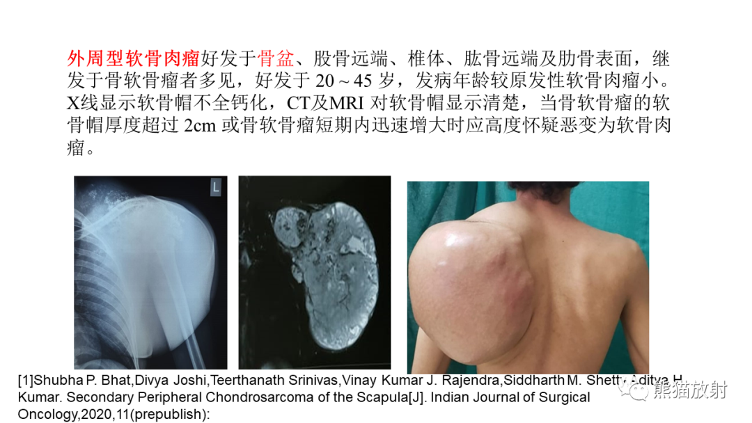 【病例】软骨肉瘤I级 VS 去分化软骨肉瘤-32