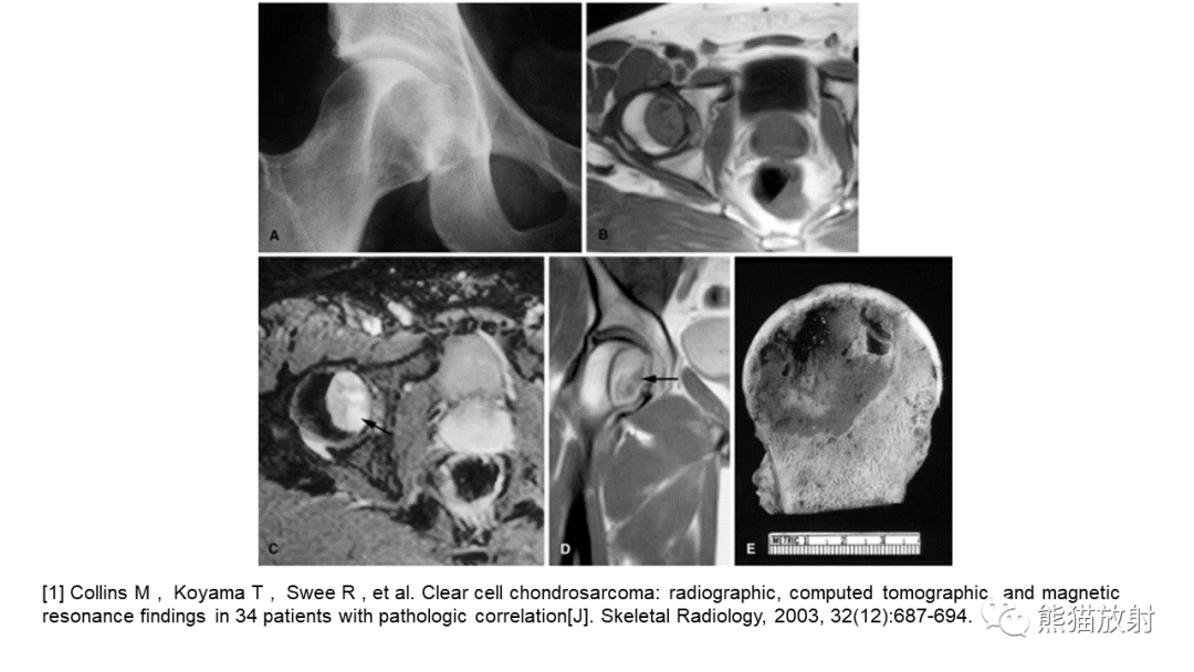 【病例】软骨肉瘤I级 VS 去分化软骨肉瘤-37