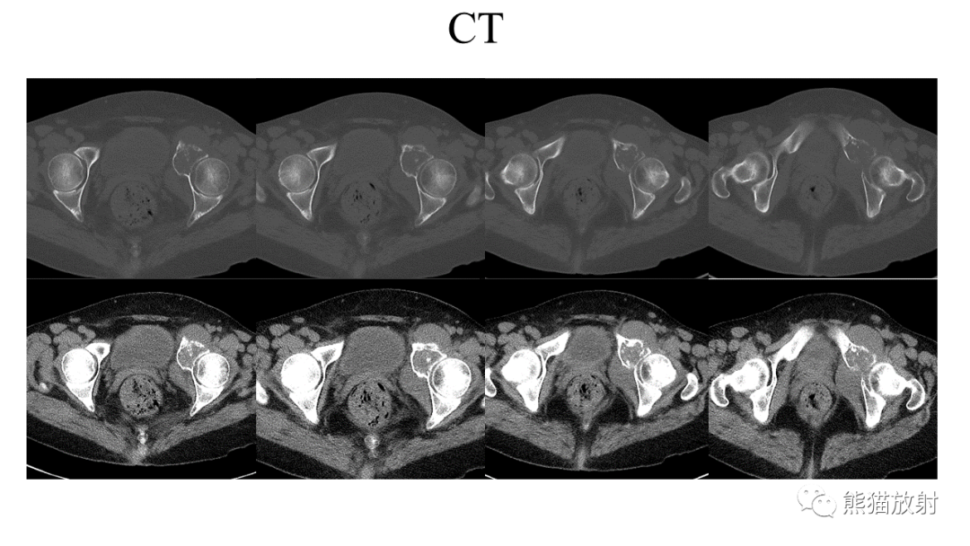【病例】软骨肉瘤I级 VS 去分化软骨肉瘤-14
