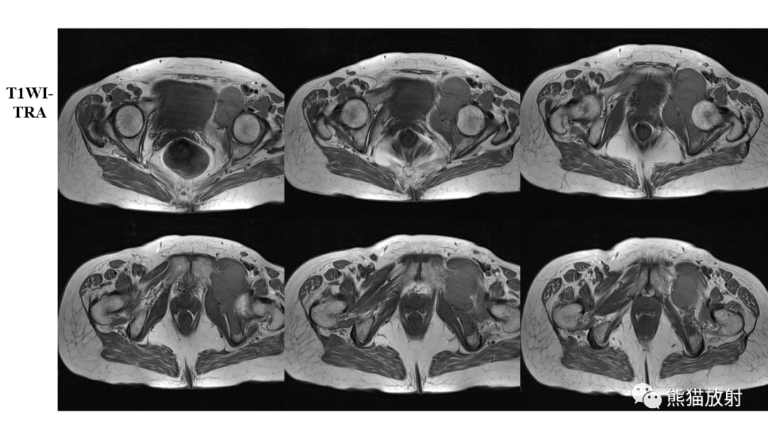 【病例】软骨肉瘤I级 VS 去分化软骨肉瘤-18