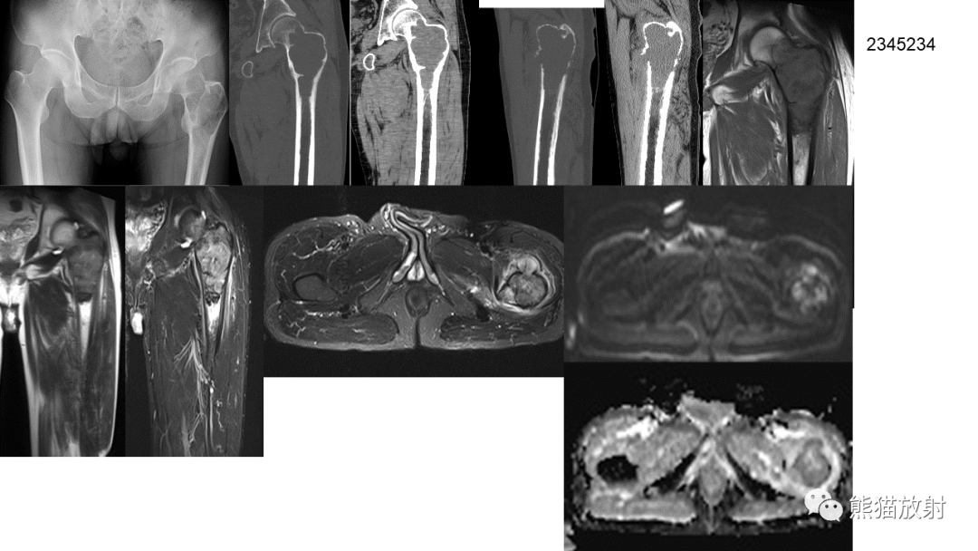 【病例】软骨肉瘤I级 VS 去分化软骨肉瘤-52