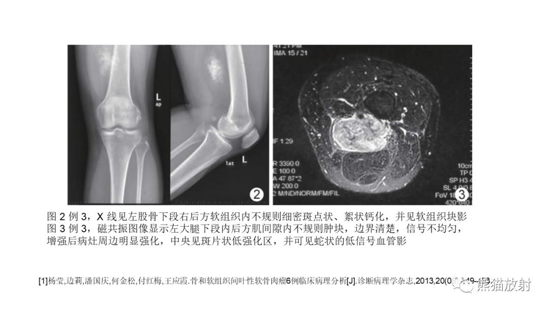 【病例】软骨肉瘤I级 VS 去分化软骨肉瘤-39