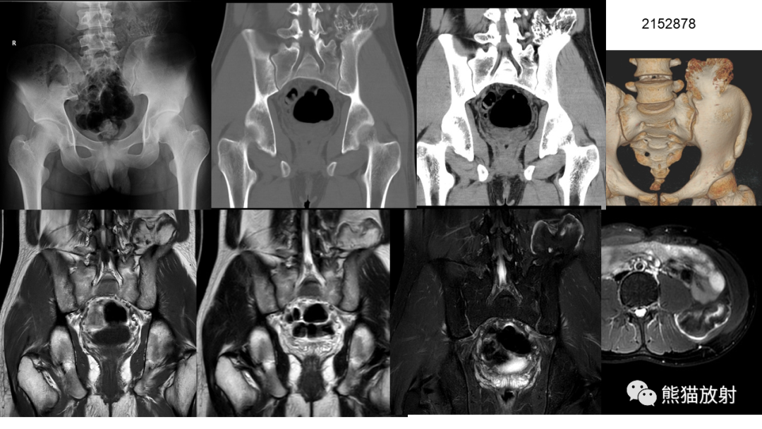 【病例】软骨肉瘤I级 VS 去分化软骨肉瘤-58