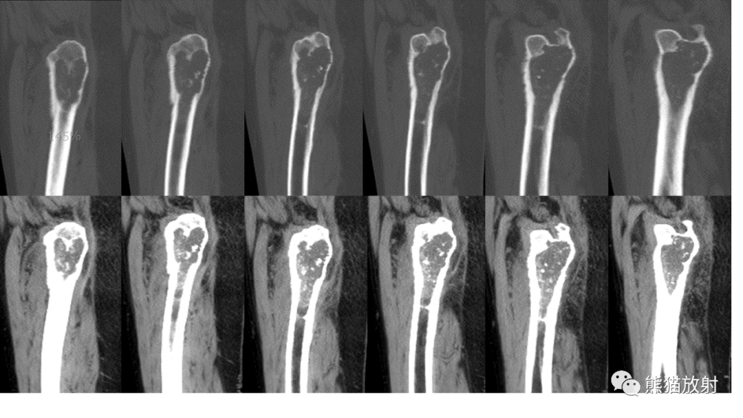 【病例】软骨肉瘤I级 VS 去分化软骨肉瘤-6