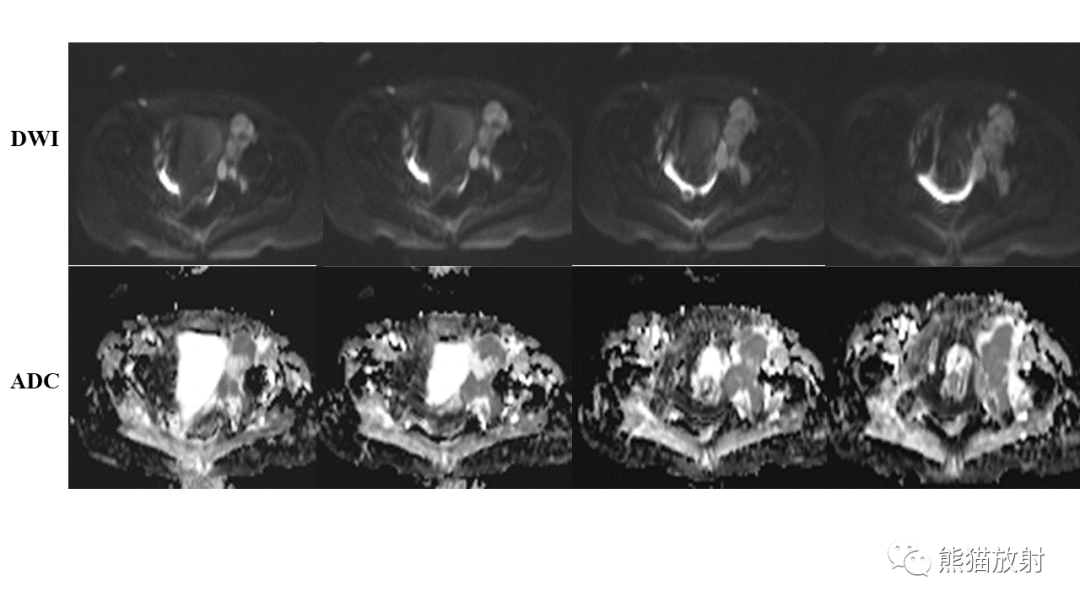 【病例】软骨肉瘤I级 VS 去分化软骨肉瘤-21