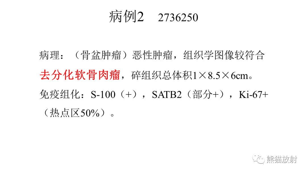 【病例】软骨肉瘤I级 VS 去分化软骨肉瘤-25