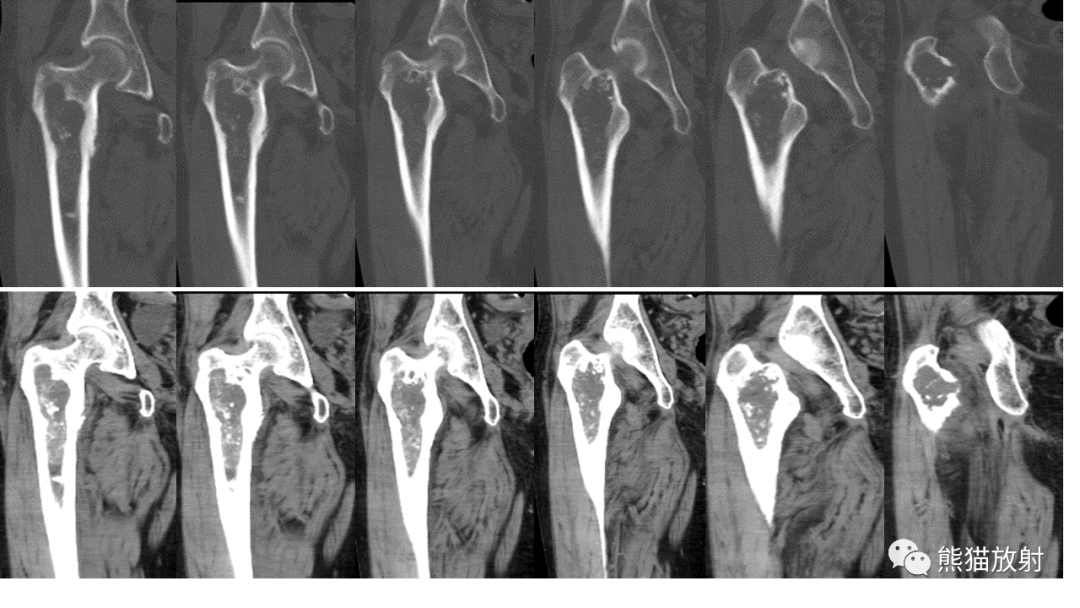 【病例】软骨肉瘤I级 VS 去分化软骨肉瘤-5