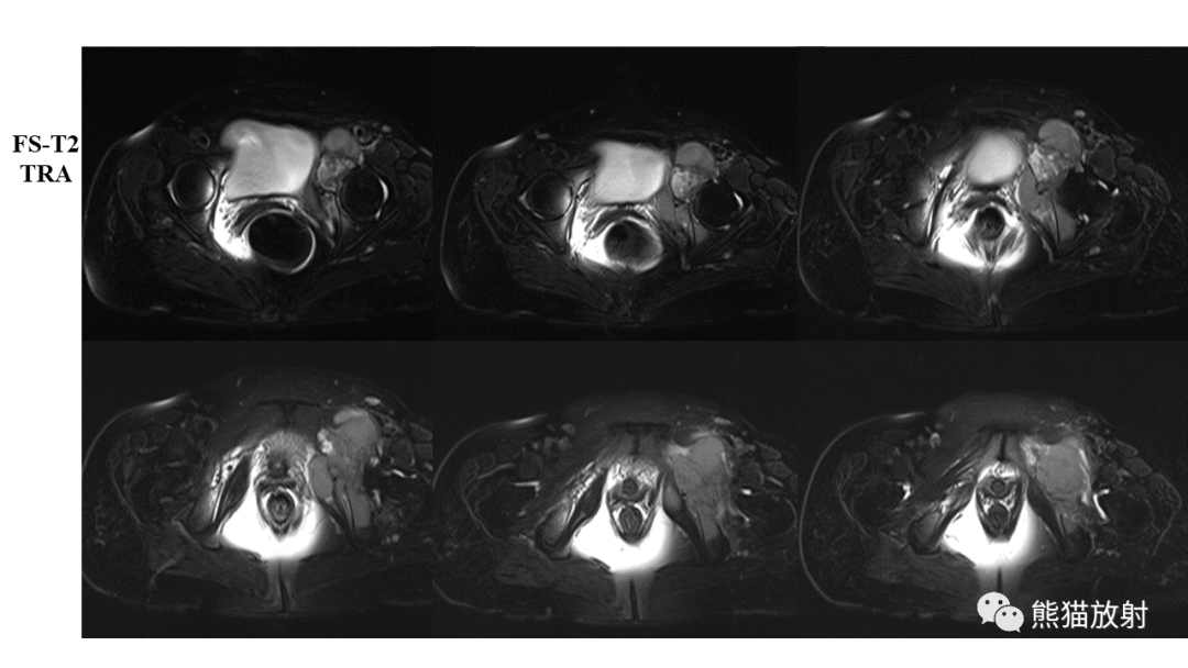【病例】软骨肉瘤I级 VS 去分化软骨肉瘤-20