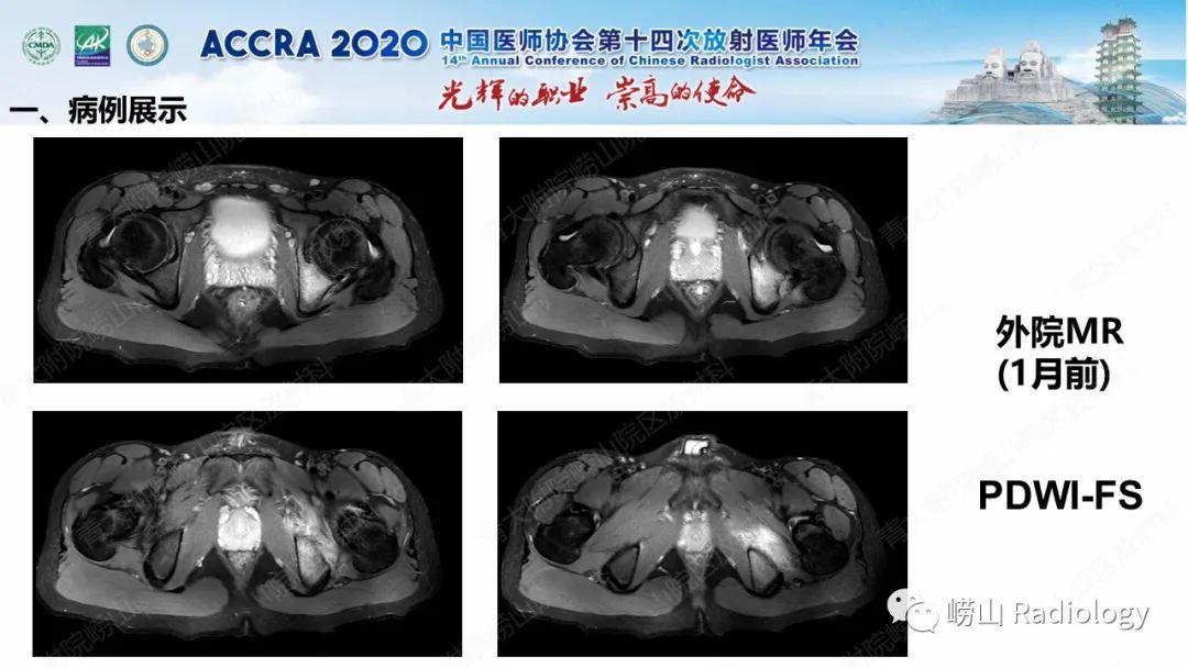 【PPT】关节内骨样骨瘤的影像诊断-15