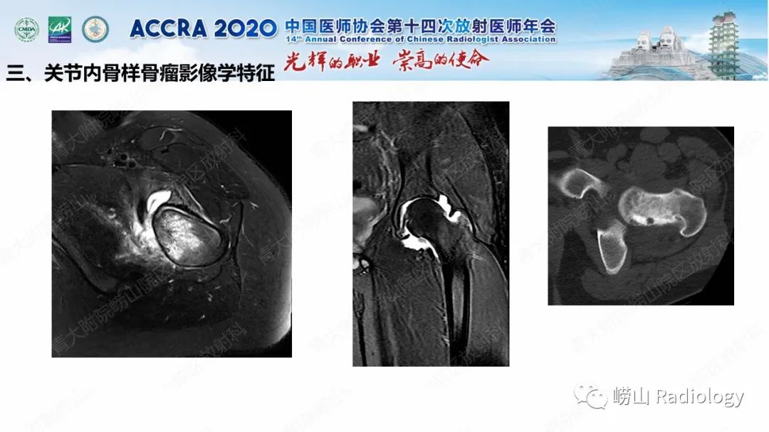 【PPT】关节内骨样骨瘤的影像诊断-33