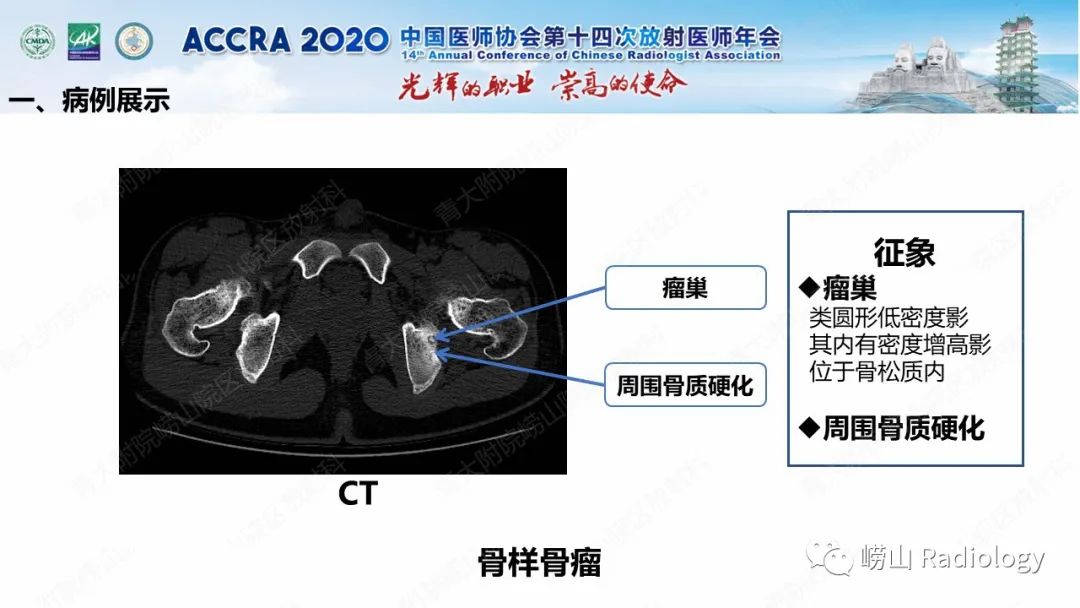 【PPT】关节内骨样骨瘤的影像诊断-18