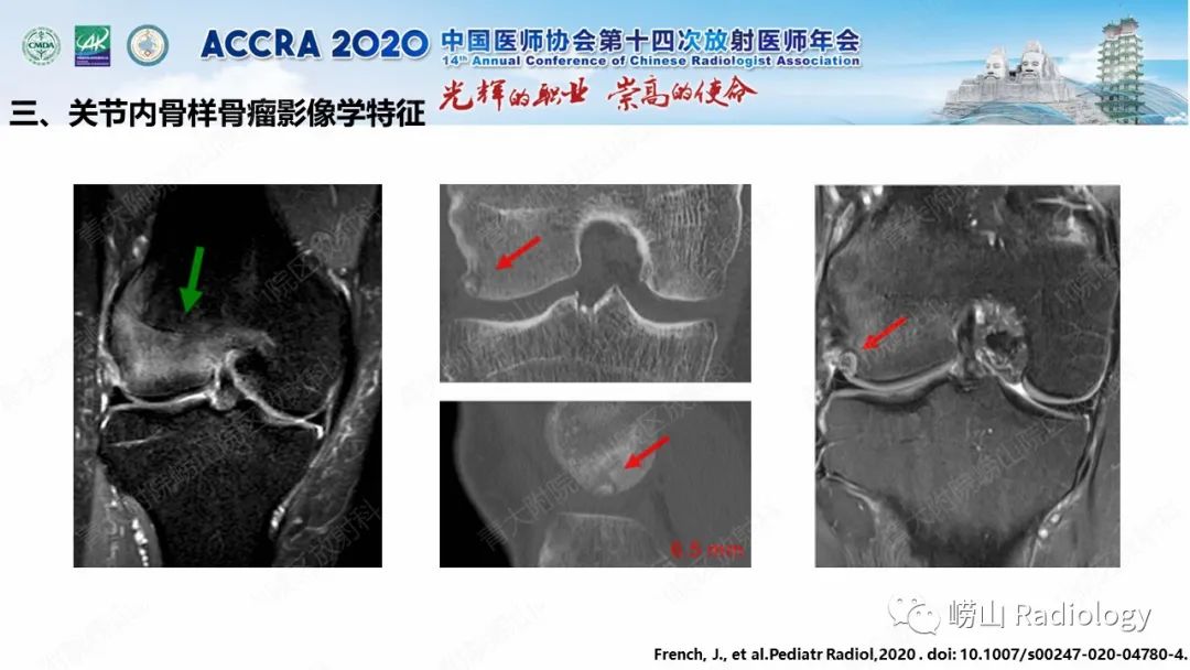 【PPT】关节内骨样骨瘤的影像诊断-34