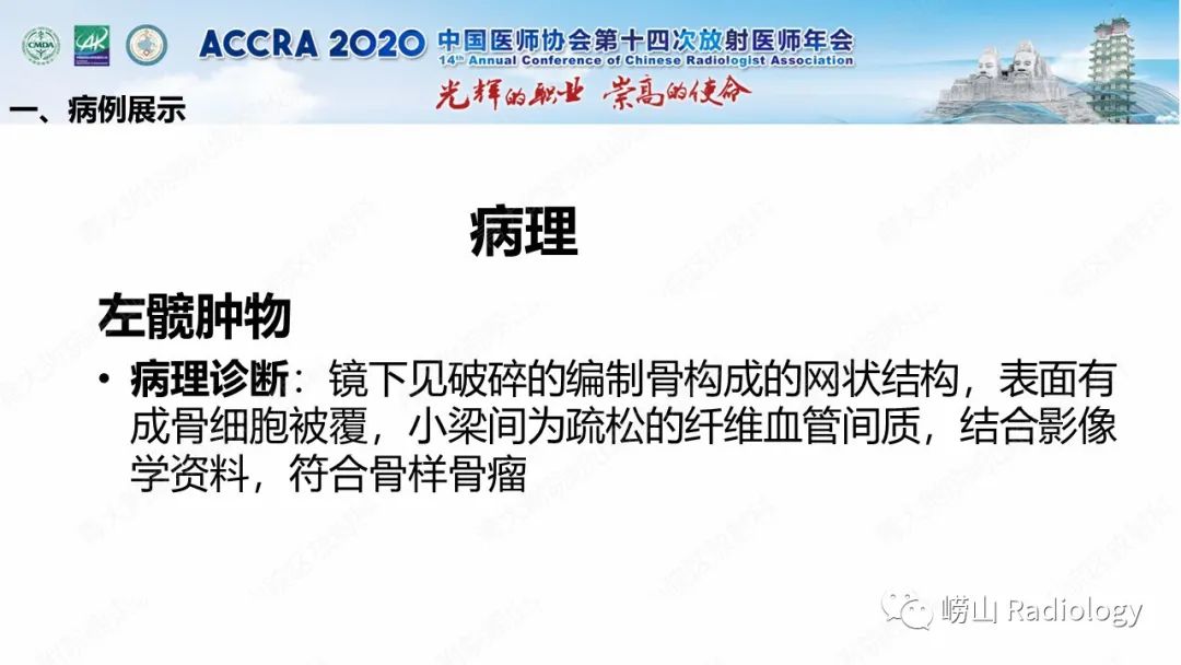 【PPT】关节内骨样骨瘤的影像诊断-19