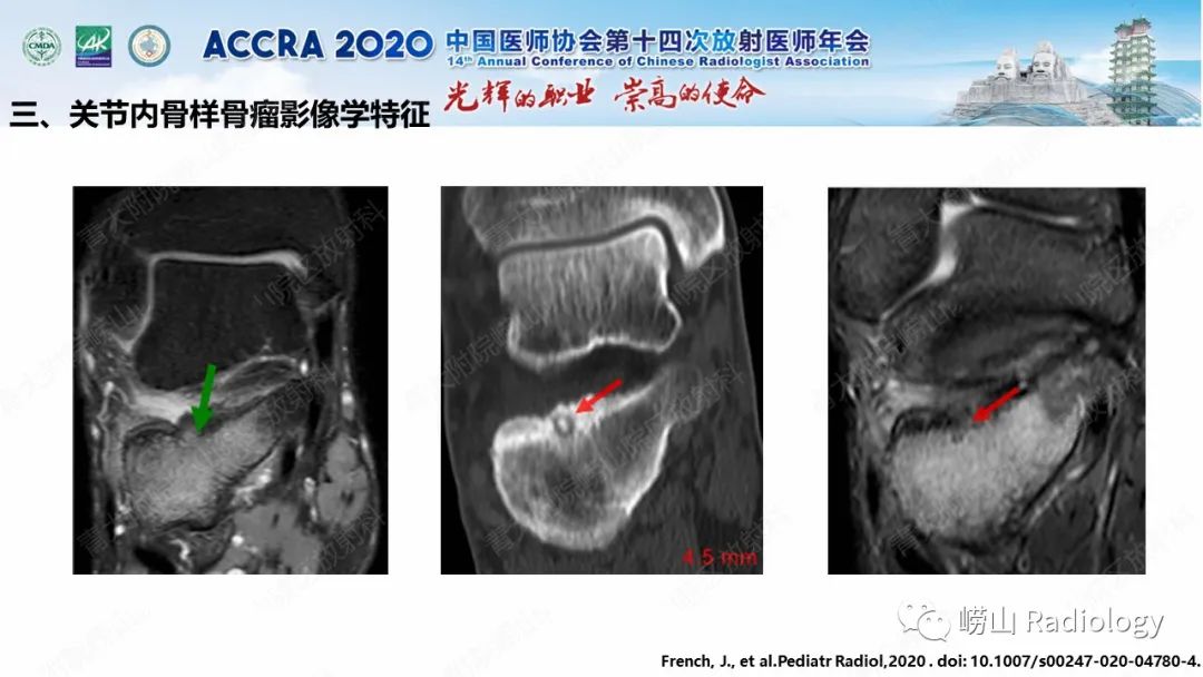 【PPT】关节内骨样骨瘤的影像诊断-36