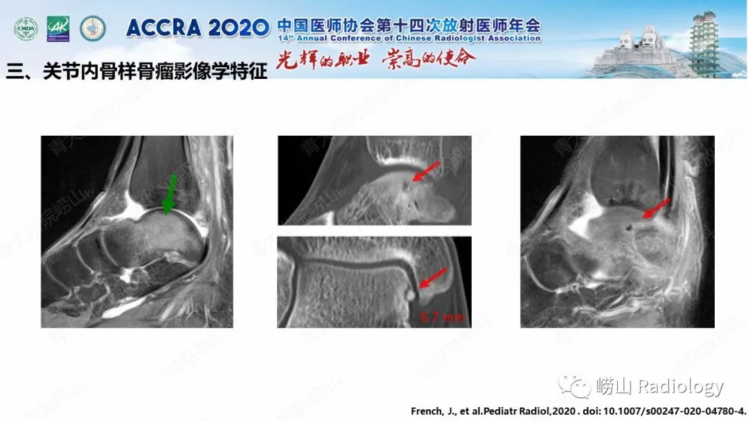 【PPT】关节内骨样骨瘤的影像诊断-37