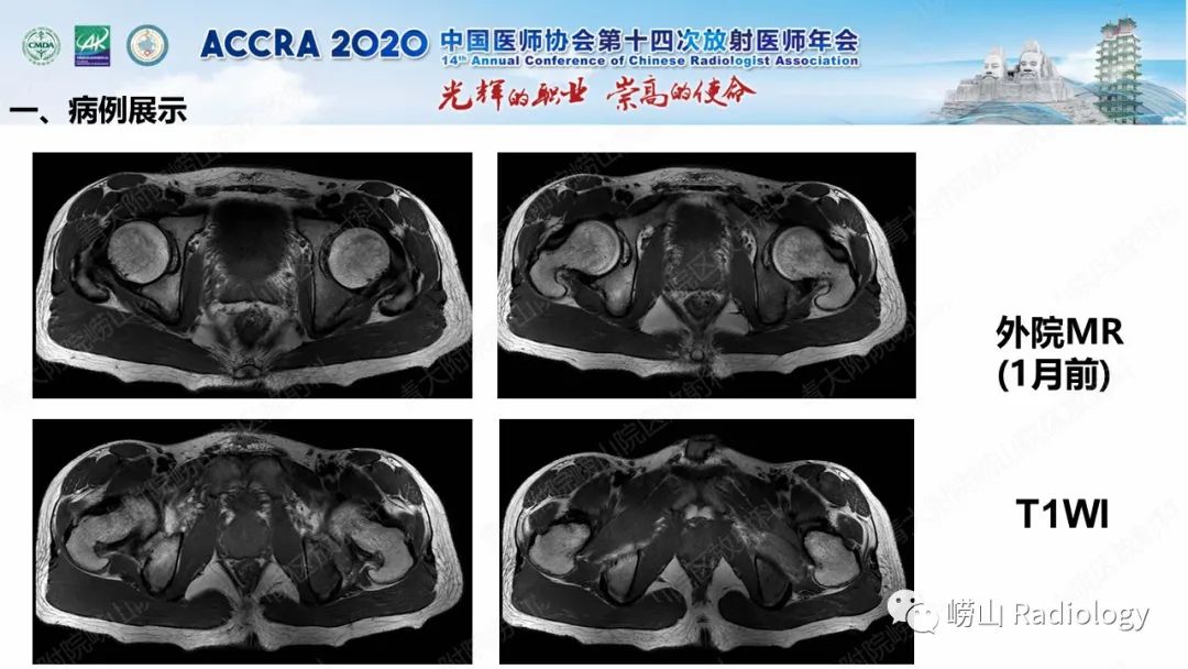 【PPT】关节内骨样骨瘤的影像诊断-14