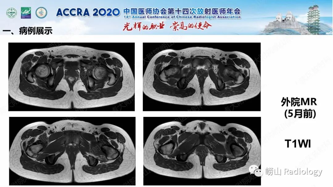 【PPT】关节内骨样骨瘤的影像诊断-4