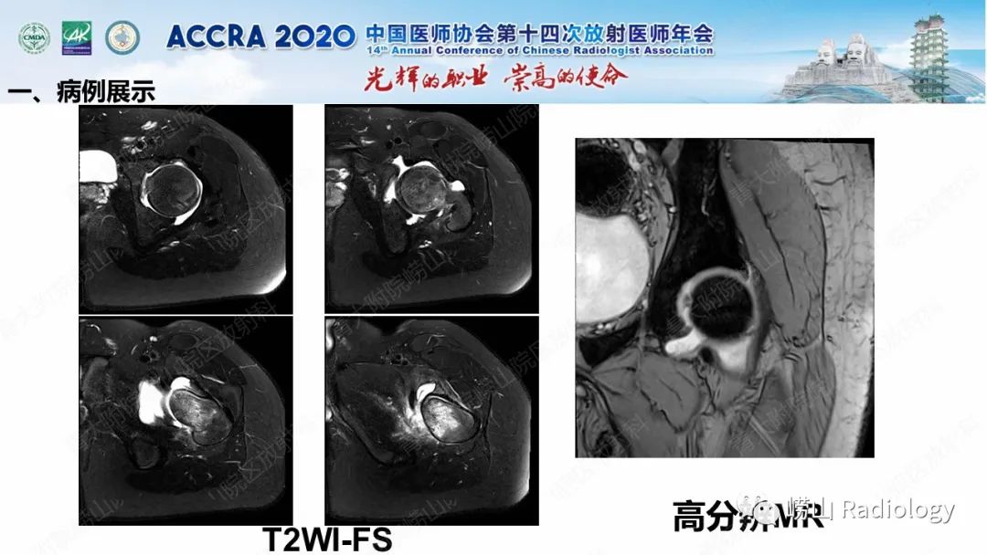 【PPT】关节内骨样骨瘤的影像诊断-7
