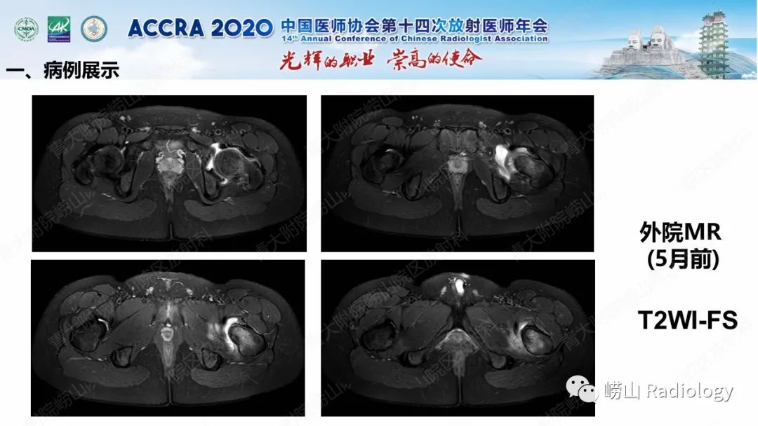 【PPT】关节内骨样骨瘤的影像诊断-5
