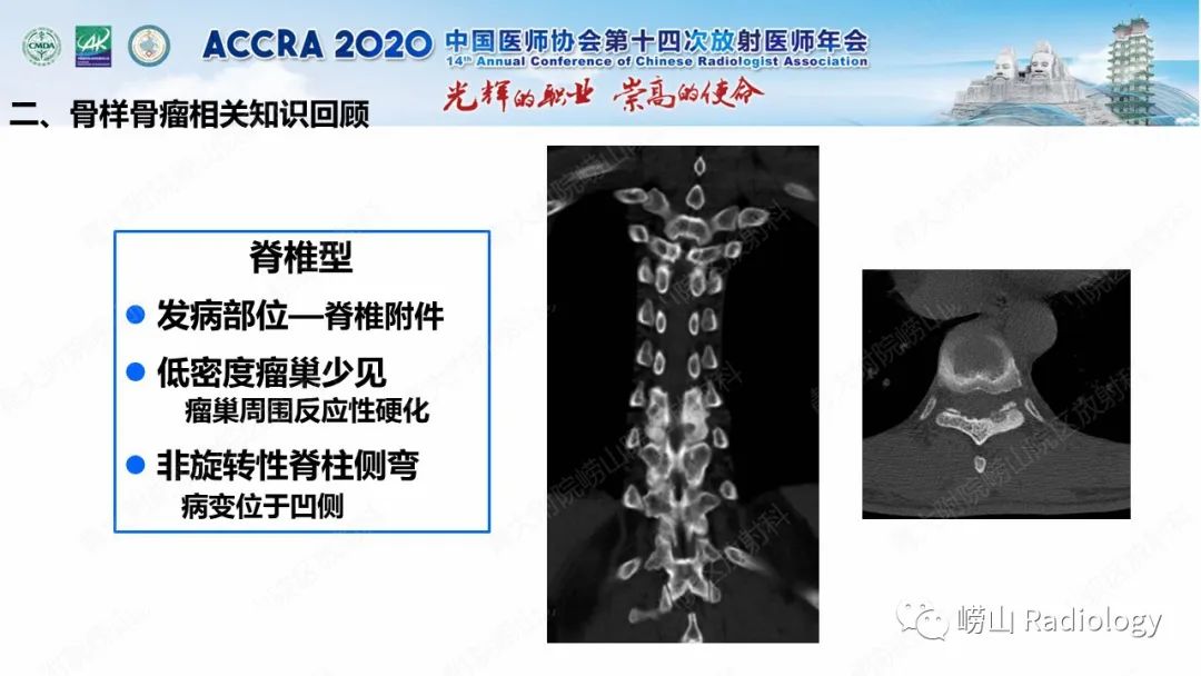 【PPT】关节内骨样骨瘤的影像诊断-28