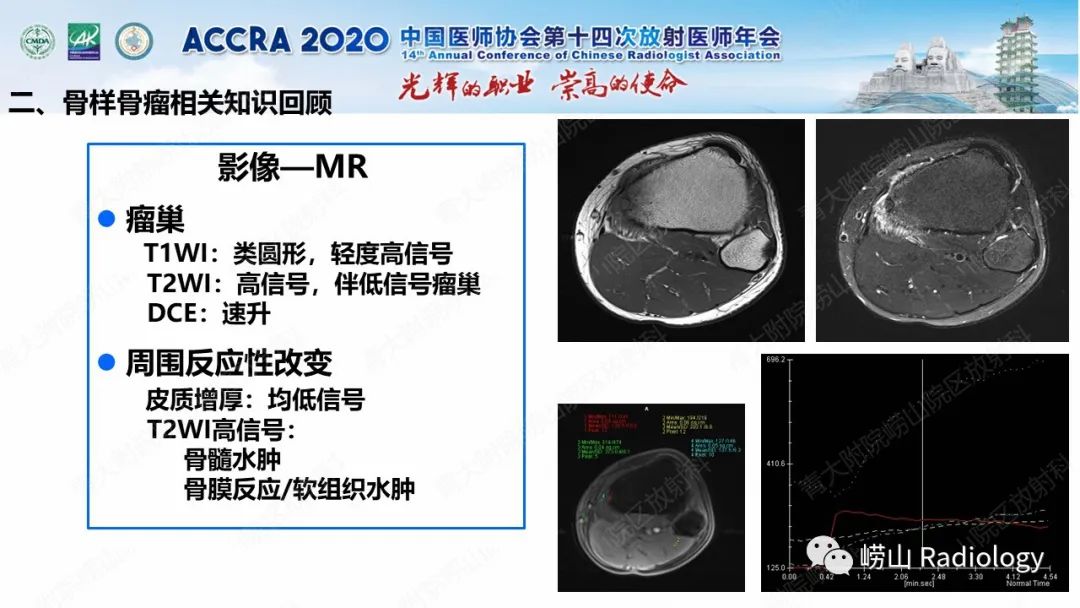 【PPT】关节内骨样骨瘤的影像诊断-24