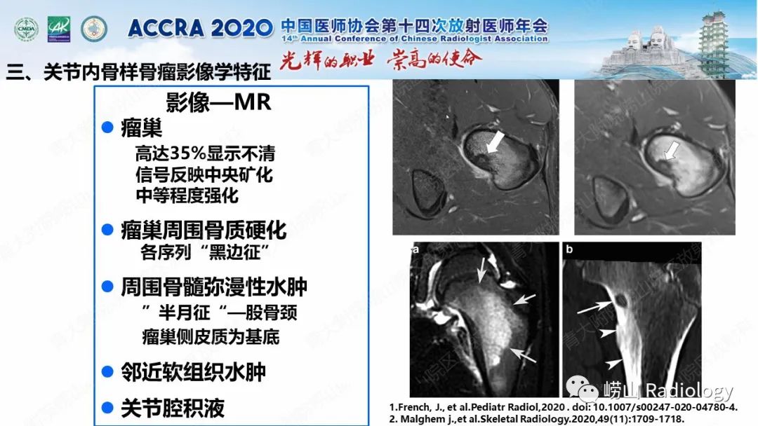 【PPT】关节内骨样骨瘤的影像诊断-32