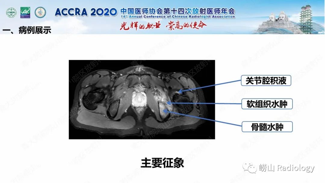 【PPT】关节内骨样骨瘤的影像诊断-17