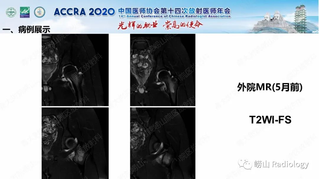 【PPT】关节内骨样骨瘤的影像诊断-6