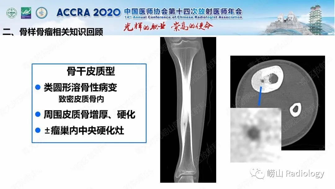 【PPT】关节内骨样骨瘤的影像诊断-25