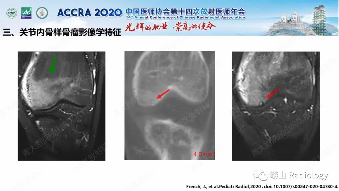 【PPT】关节内骨样骨瘤的影像诊断-35