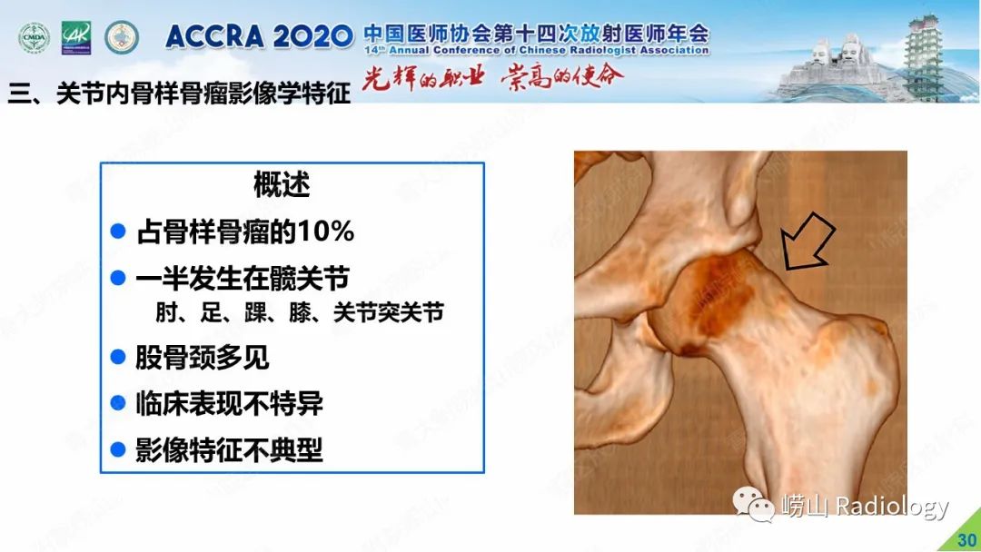 【PPT】关节内骨样骨瘤的影像诊断-29