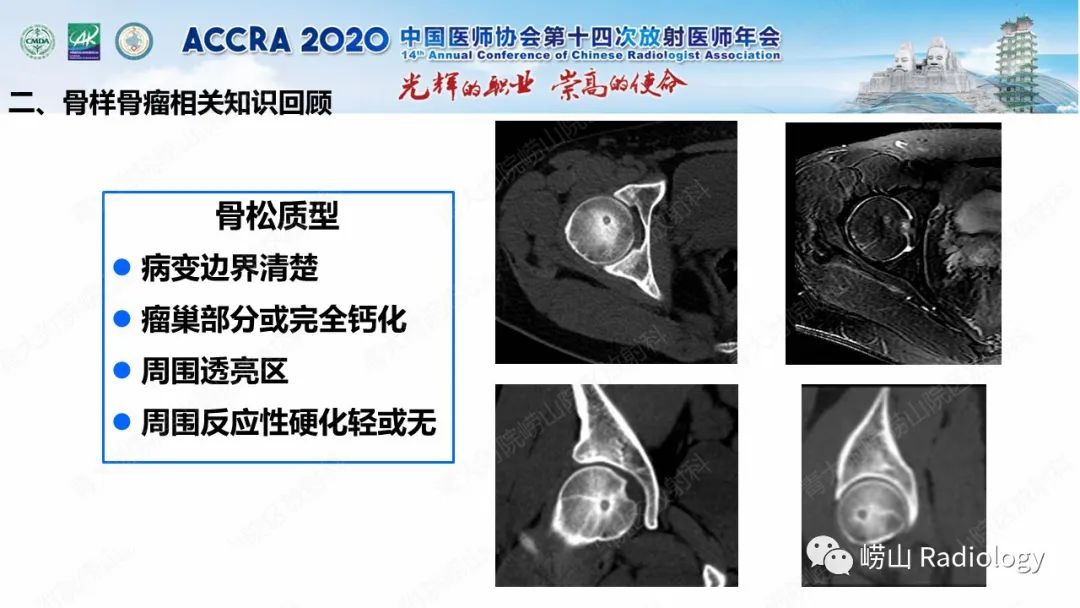【PPT】关节内骨样骨瘤的影像诊断-27