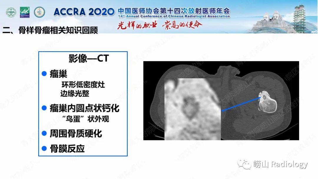 【PPT】关节内骨样骨瘤的影像诊断-23