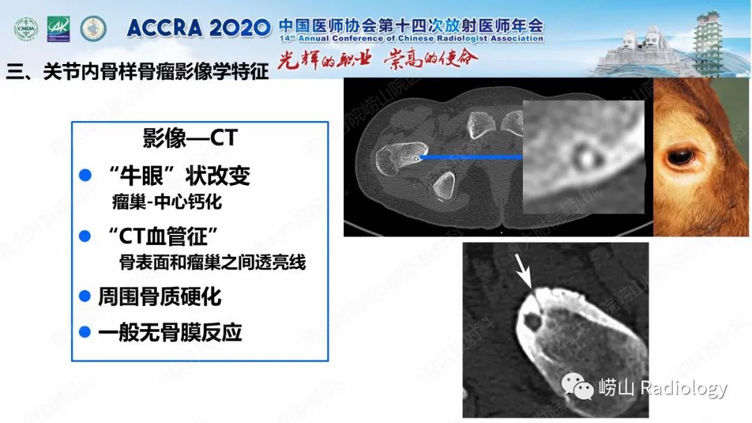 【PPT】关节内骨样骨瘤的影像诊断-31