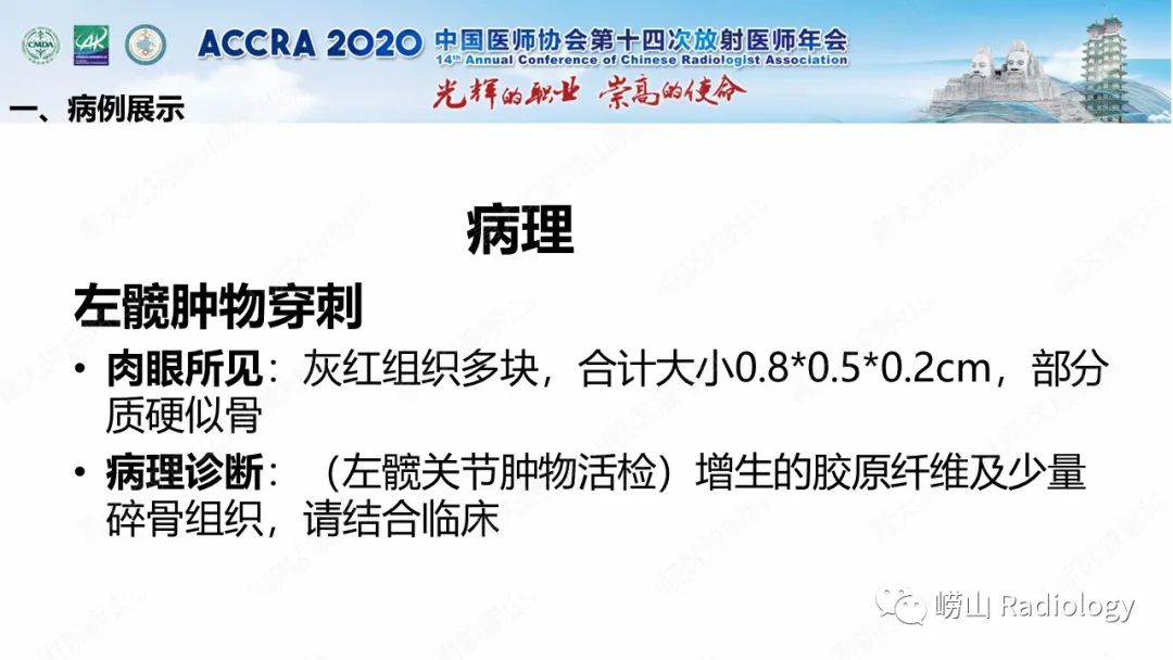 【PPT】关节内骨样骨瘤的影像诊断-11