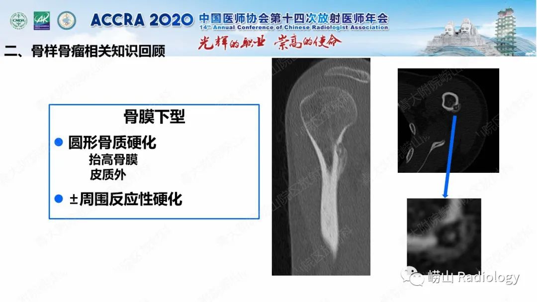 【PPT】关节内骨样骨瘤的影像诊断-26
