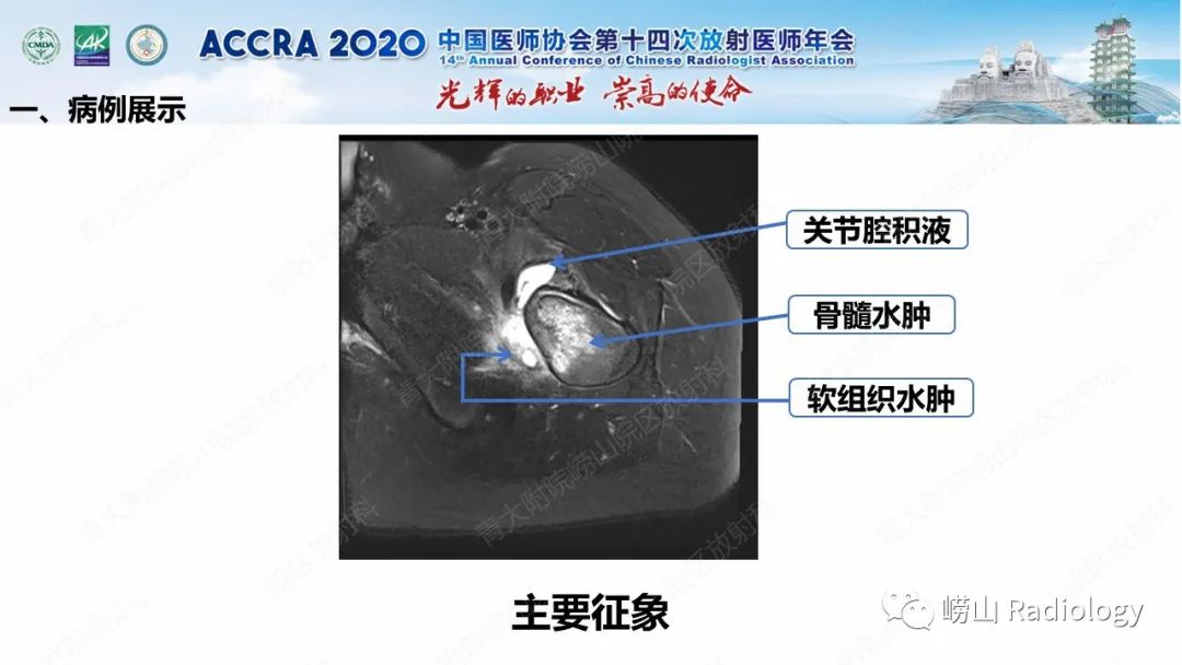【PPT】关节内骨样骨瘤的影像诊断-8