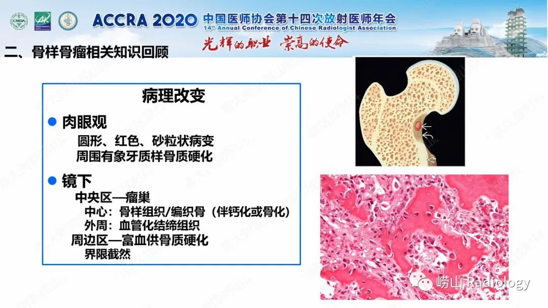 【PPT】关节内骨样骨瘤的影像诊断-21