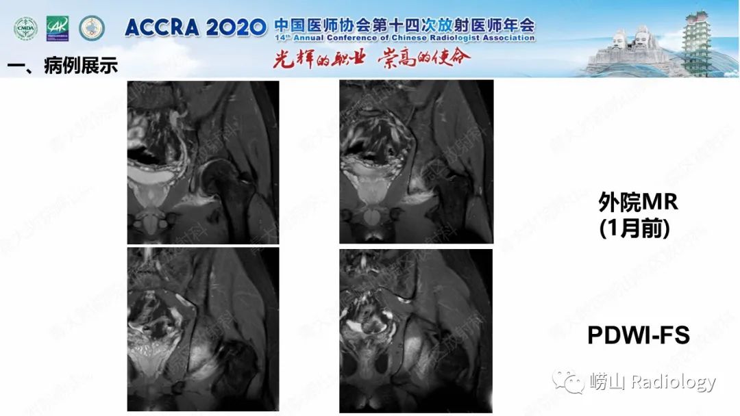 【PPT】关节内骨样骨瘤的影像诊断-16