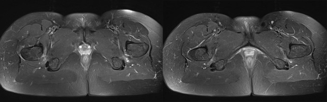 【病例】坐骨股骨撞击综合征1例MR影像-3