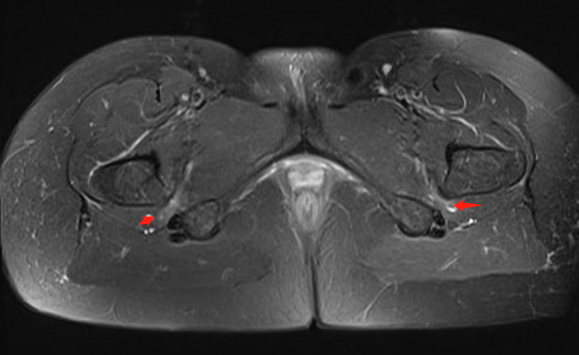 【病例】坐骨股骨撞击综合征1例MR影像-6