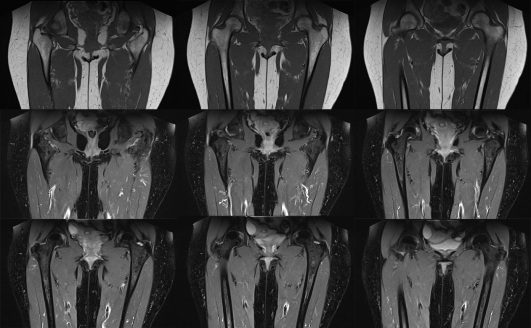 【病例】坐骨股骨撞击综合征1例MR影像-2