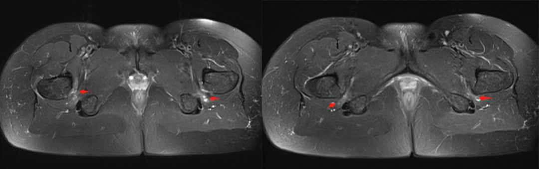 【病例】坐骨股骨撞击综合征1例MR影像-4