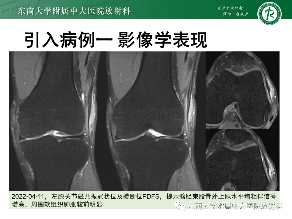 【PPT】髂胫束相关损伤-4